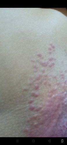 Cream para sa pangangati ng ari