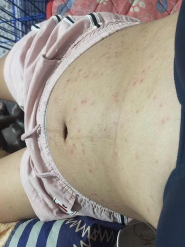 EFFECTIVE na lotion para sa kati kapag buntis!!!