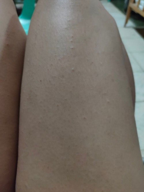 Ano kaya ang mga butlig na ito?