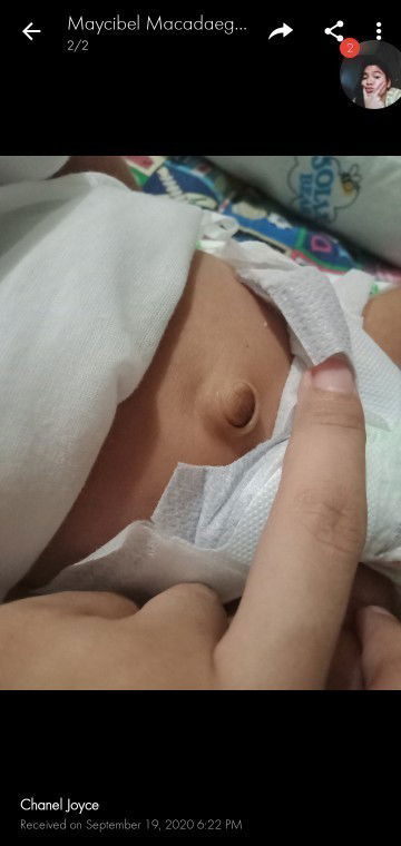 Questions about Luslos (umbilical hernia)