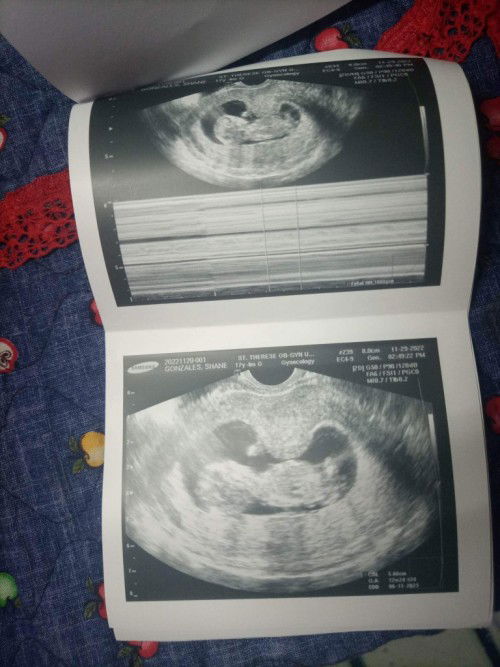 13weeks&2days bakit po hindiko ramdam SI baby? Parang normal lng din po tiyan ko pero nag pacheck up