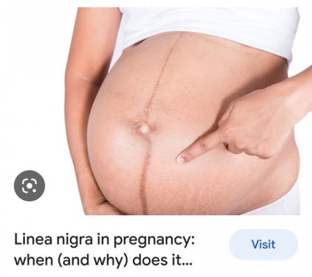 Hi mommies. Linea nigra ni hilang tak lepas bersalin? Or ada cara untuk hilangkan please share ya