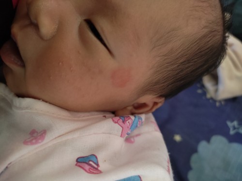 ตุ่มขึ้นหน้าแบบนี้คืออะไรค่ะ
