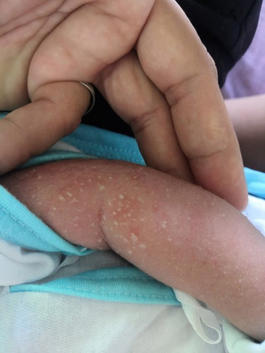 Ano po ang pwedeng gamot sa rashes ni baby? 11 days old palang po