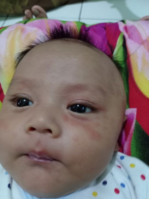 Bruntusan pada bayi 2 bulan