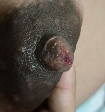 Nipple problem