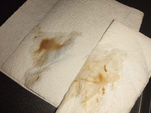 Puro mucus discharge lang , hindi nag poprogress ang pag open ng cervix.