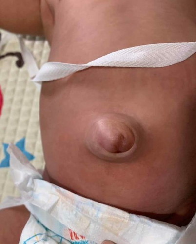 Pusat bayi timbul (hernia) baby girl