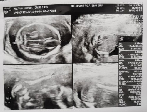 Bund, kalau BBJ 205gr di usia 17 minggu apakah masih normal?