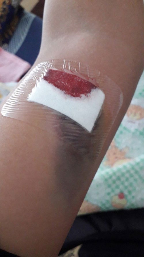 SETELAH PASANG KB IMPLAN