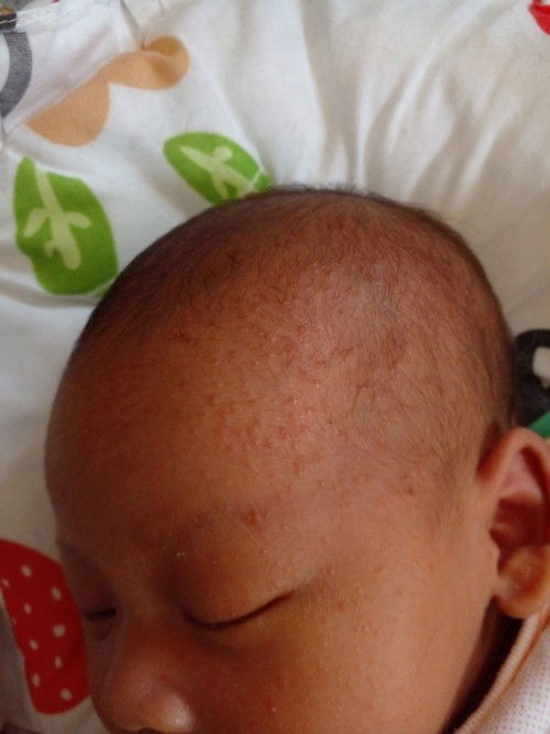 ขอสอบถามหน่อยคะผื่นขึ้นแบบนี้อันตรายไหมคะควรไปหาหมอหรือมีวิธีอื่นทำไงคะช่วยแนะนำหน่อยคะ