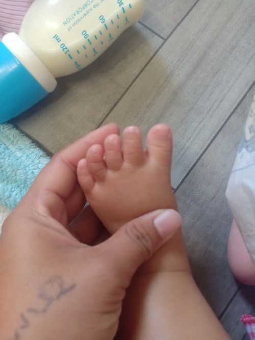 นิ้วเท้าแบบนี้ปกติไหม?