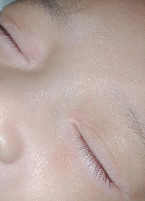 pamumula ng balat sa mata