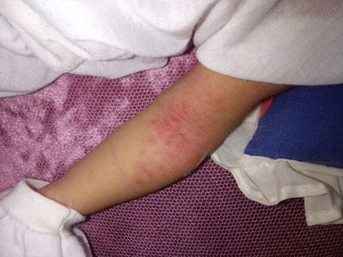 May ganito po yung anak ko ano po pwedeng ipang alis