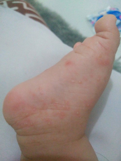 Kulit bayi merah lenting air