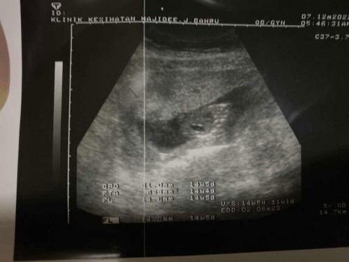 Siapa tahu tengok Scan 14week