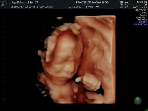 USG 4D, usia kandungan 22 week 2 day. Share foto USG 3 bunda2 dong 🥰