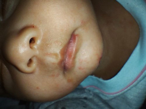 Anak ku umur 4 bulan sakit cacar