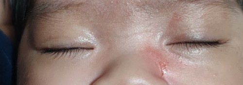 Baby face Accidentally scratch