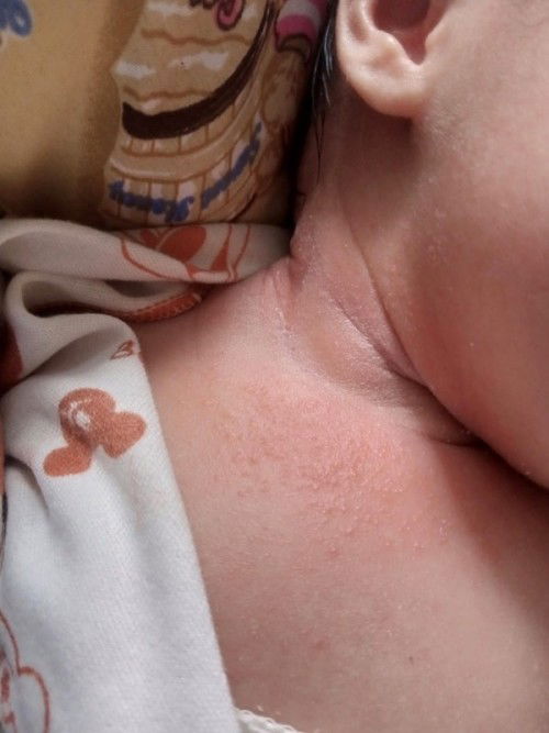 Bun aku new mom🥺baby ku usia 11 hari,dileher baby ku ada bintik² merah