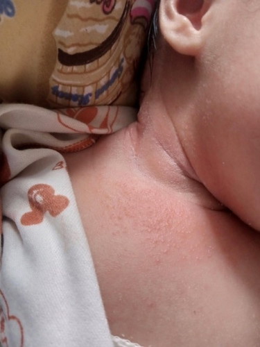 Bun aku new mom🥺baby ku usia 11 hari,dileher baby ku ada bintik² merah