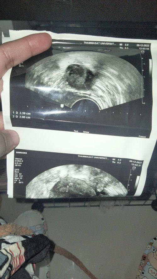 แม่ๆท่านไหนเคยเป็นบ้างคะวันนี้ไปตรวจครรภ์ซาวภายในพบว่าแท้ง(น้องหลุดไปแล้ว) เจอแต่รังไข่ 
ทำยังงัยดี