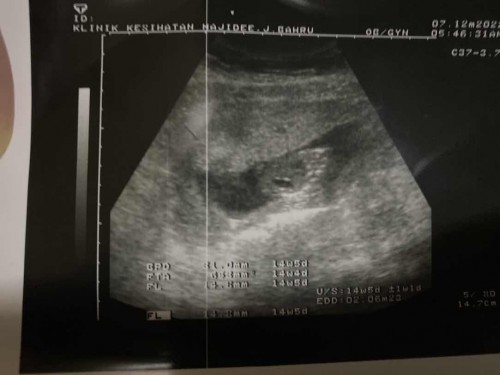 TAHU SCAN BABY BAHAGIAN MANA?