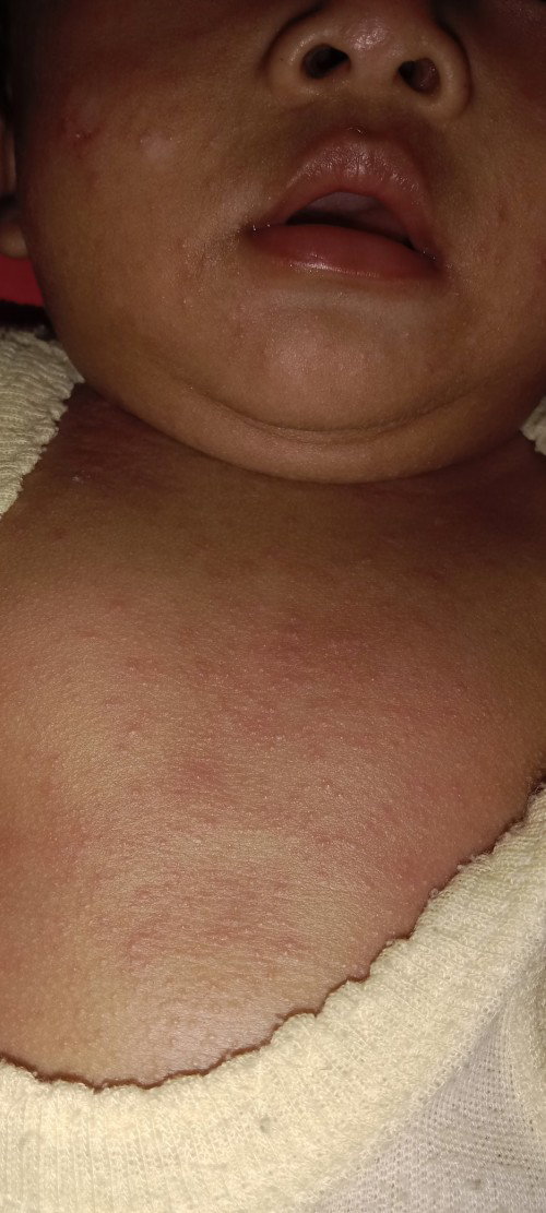 Merah merah badan badan bayi usia 4 bulan 15 hari