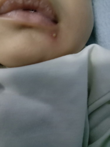 Jerawat nanah