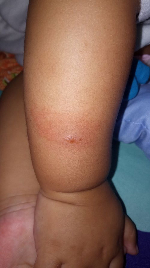 Sudah periksa dokter, anak masih bentol merah berair?🥲