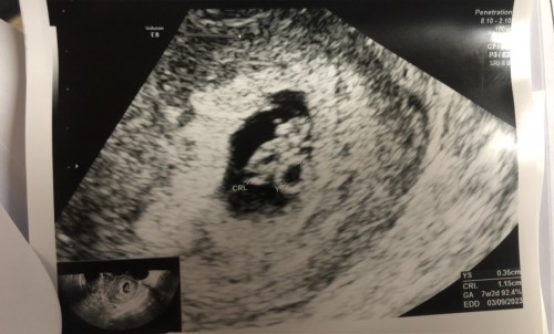 Transvaginal Ultrasound