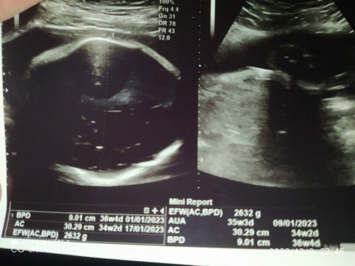 akurat mana hitungan hpl kalender atau hpl USG??