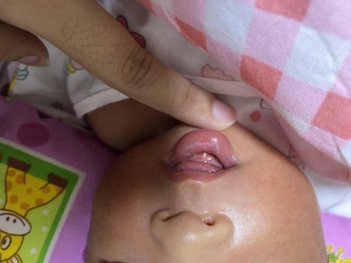 สอบถามปากลูกเป็นอะไร