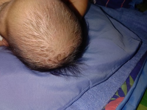 Cradle cap ni baby