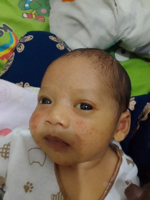 Bruntus pada pipi bayi