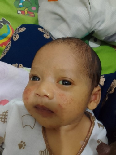 Bruntus pada pipi bayi