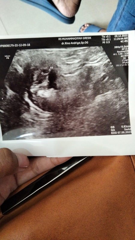Fleek 3hari semakin banyak usia kndungan mnrut usg 5mgg menurut hpht 7mnggu