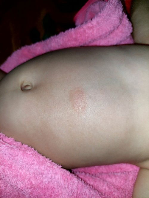 Kulit kering pada perut bayi