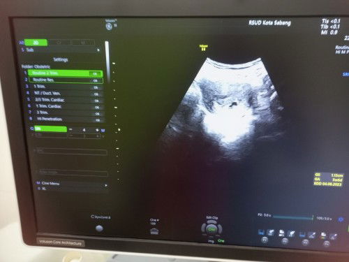 Bun saya hamil 6jalan7minggu.tp sy kena penyakit usus buntu ,bahaya gk y Bun ke janin🥺