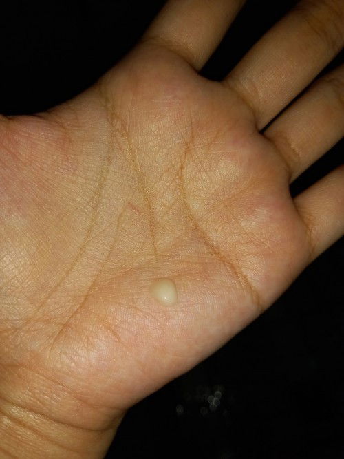 สอบถามแม่ๆที่ท่อน้ำนมอุดตันแล้วนวดเปิดท่อมา