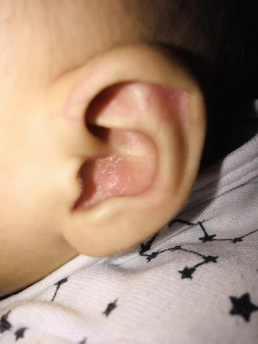 Bat kaya po ganyan ang tainga ng anak ko
