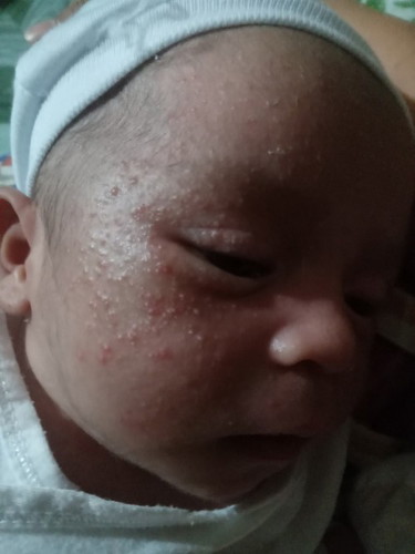 RASHES SA MUKHA