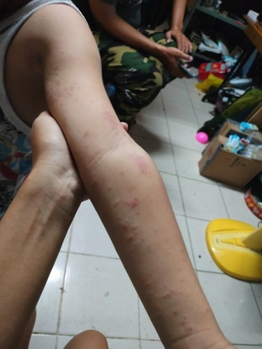 ผื่นแบบนี้บ้านไหนเคยเป็นมั้ยค่ะ