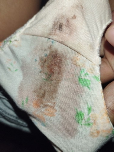 Brown discharge