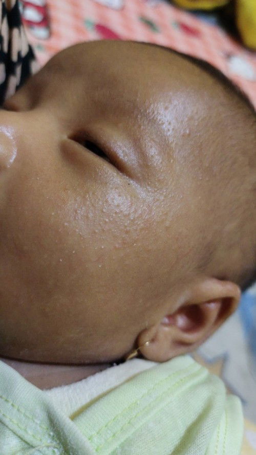 Bintik di seluruh muka