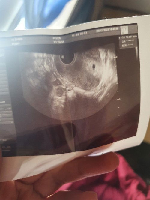 Bun, perkiraan 6 minggu, tapi kantung kehamilan masih kecil,,dan pendarahan