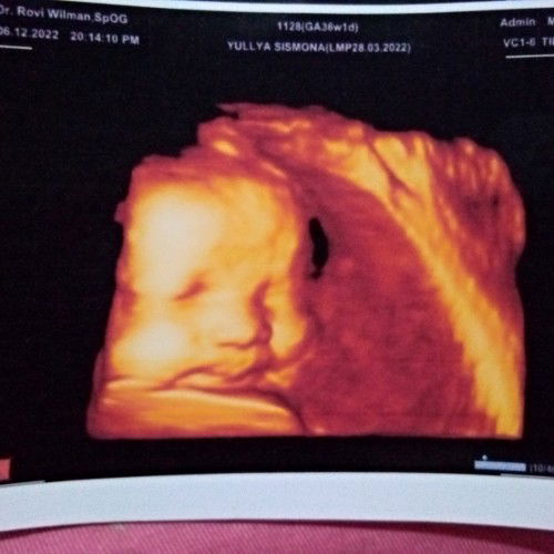 Ada ngk Bun, hpl nya maju pas USG pertama hplnya 8januari 
5hari yang lalu USG lagi hplnya 26des ini