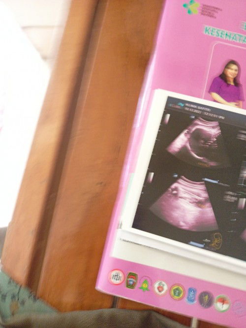 Sedih Bayi msh Sungsang