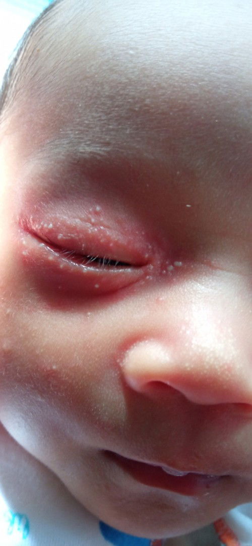 Bintik dan bengkak memerah pada mata bayi 3minggu