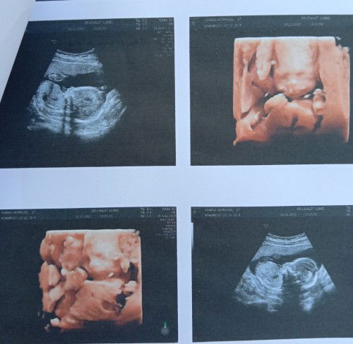 18สัปดา+1
เป็นผ.ญ.มั้ยค่ะแบบนี้🥰